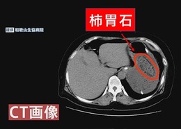 柿胃石って何ぁに