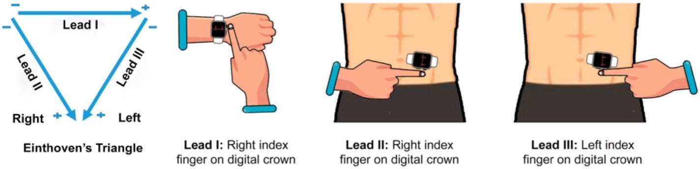 Follow the diagram to get an accurate three lead ECG from your Apple Watch - Research shows that the Apple Watch could alert users of a heart attack