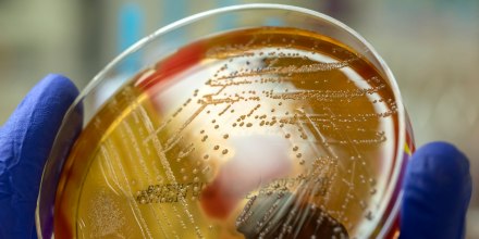 A microbiologist holding a blood agar plate showing the beta-hemolysis caused by pathogenic bacteria Streptococcus pyogenes. 