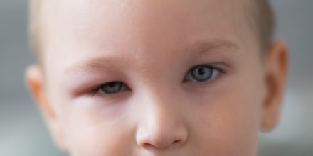 Little boy with swollen eye