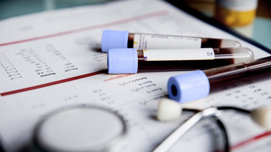 Vials of blood to test for total iron binding capacity (TIBC) -1.