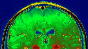 Manipulationsskandal erschüttert Alzheimer- und Parkinsonforschung