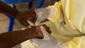 Sorge wegen Ausbreitung des Mpox-Virus in Afrika