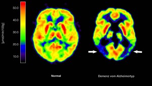 Ist gegen Alzheimer denn gar kein Kraut gewachsen?