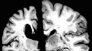 Wo bitte geht es zum Alzheimer-Medikament?