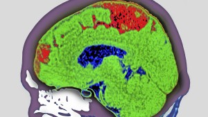 Wie eine neue Therapie die Folgen eines Schlaganfalls mildern könnte