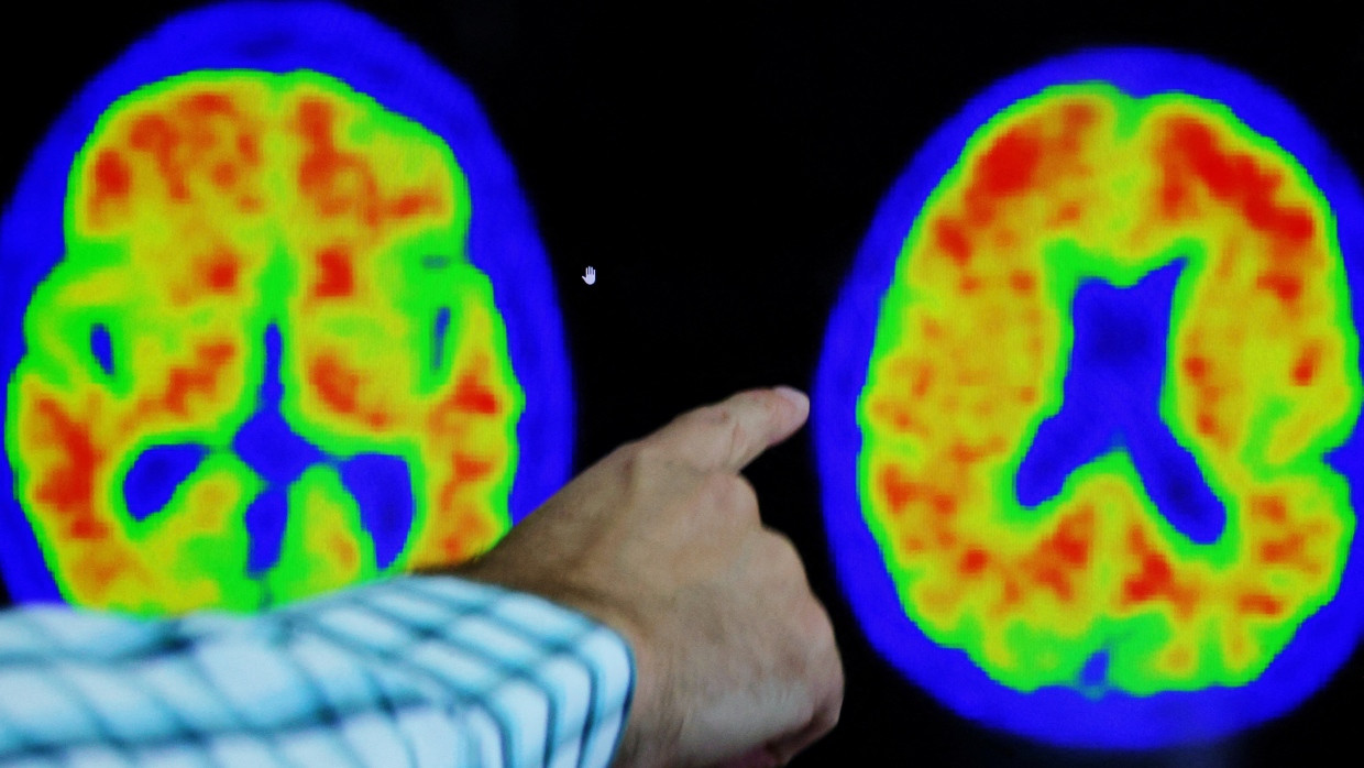 Neue Antikörpermedikamente bekämpfen die für Alzheimer charakteristischen Ablagerungen im Gehirn.