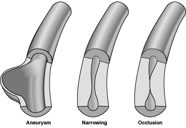 Microscopic Polyangitis Narrowing