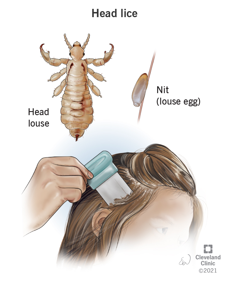 Head lice are tiny insects that live in a person’s head hair. You can find head lice or lice eggs (nit) by running a fine-toothed comb through your hair.