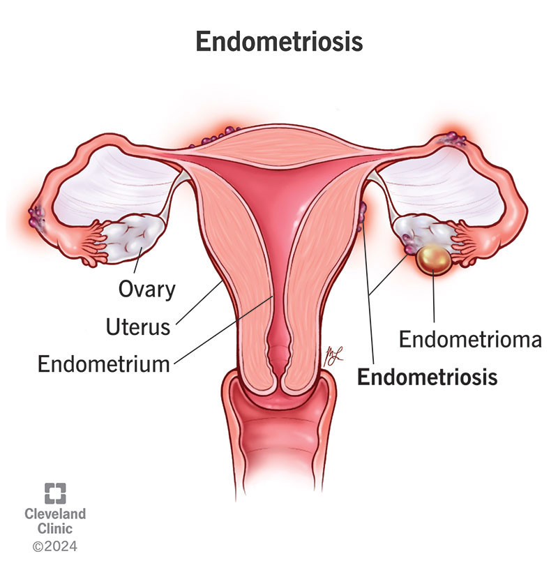 Endometriosis and an endometrioma in the female reproductive system