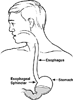 Esophageal PH Test