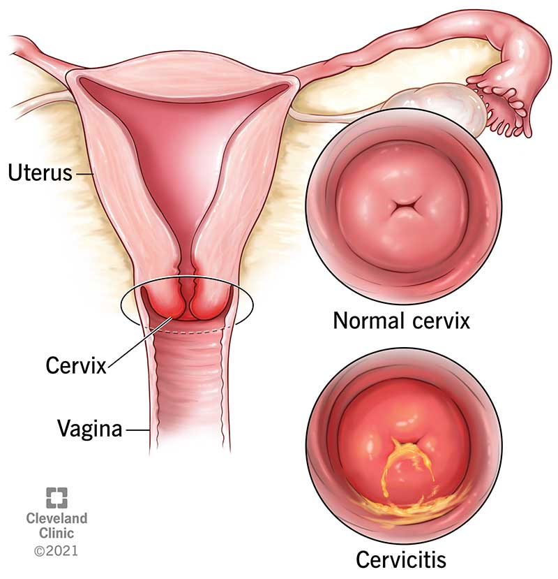 Normal cervix vs cervix with cervicitis