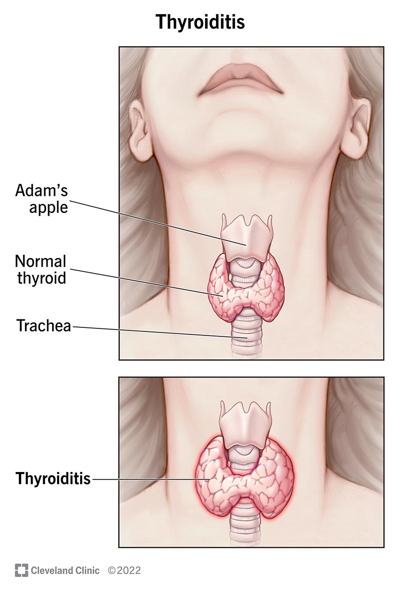 Illustration of a normal thyroid that wraps around the trachea below the Adam's apple, and thyroiditis as an enlarged thyroid