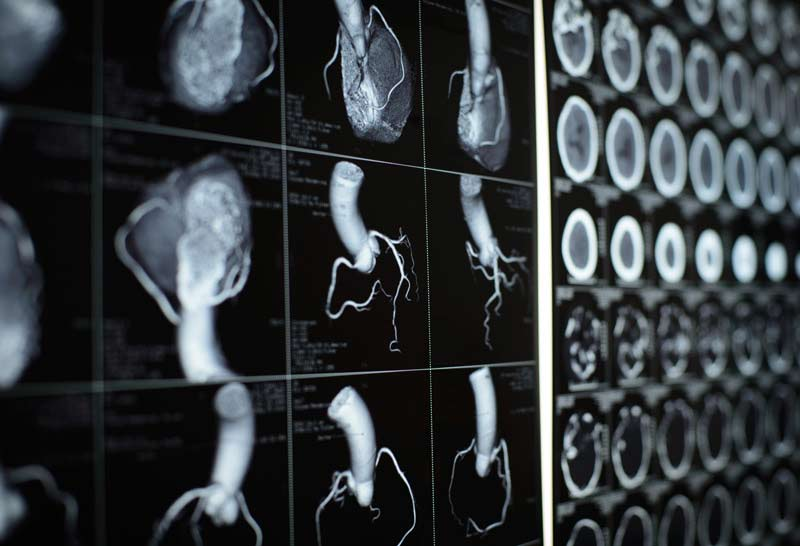 Detailed, three-dimensional X-ray images from a heart CT scan