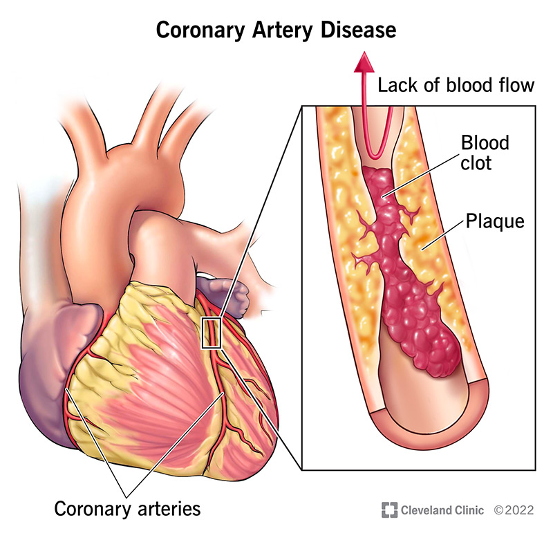 Plaque buildup in a coronary artery. Blood clots can form on the plaque and interfere with blood flow.