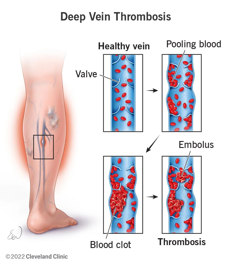 The process of deep vein thrombosis occurring inside a leg vein.