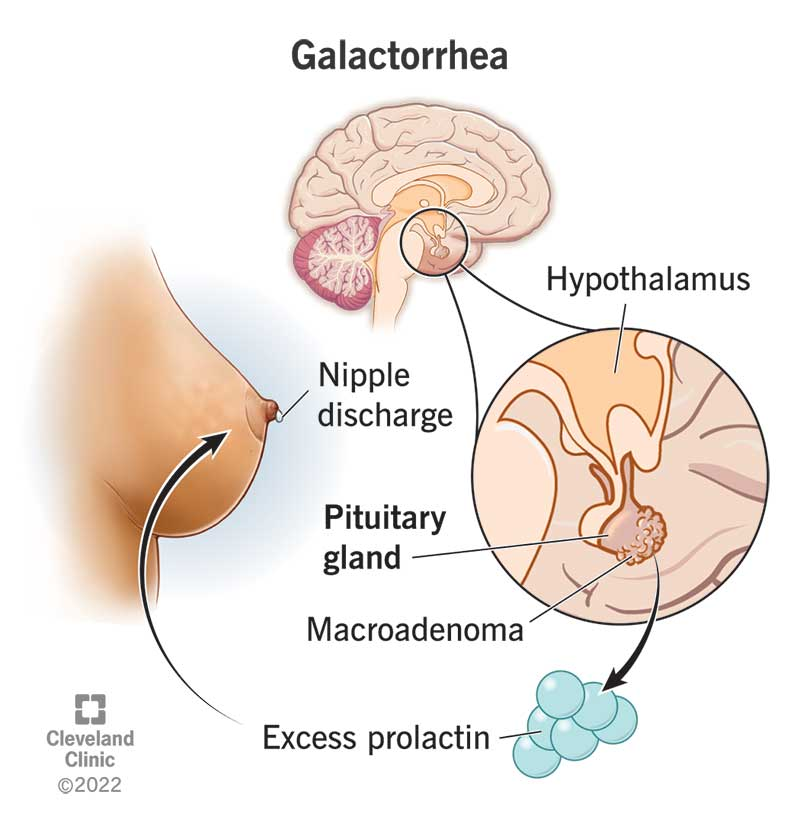 Diagram of how excess prolactin causes your brain to think you're lactating when you aren't