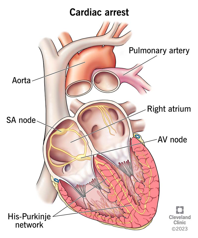 Cardiac arrest happens because of an issue with your heart’s electrical system.