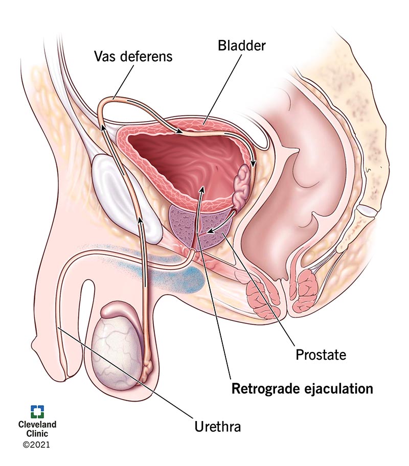 Male reproductive system showing the path of semen into the bladder due to retrograde ejaculation.