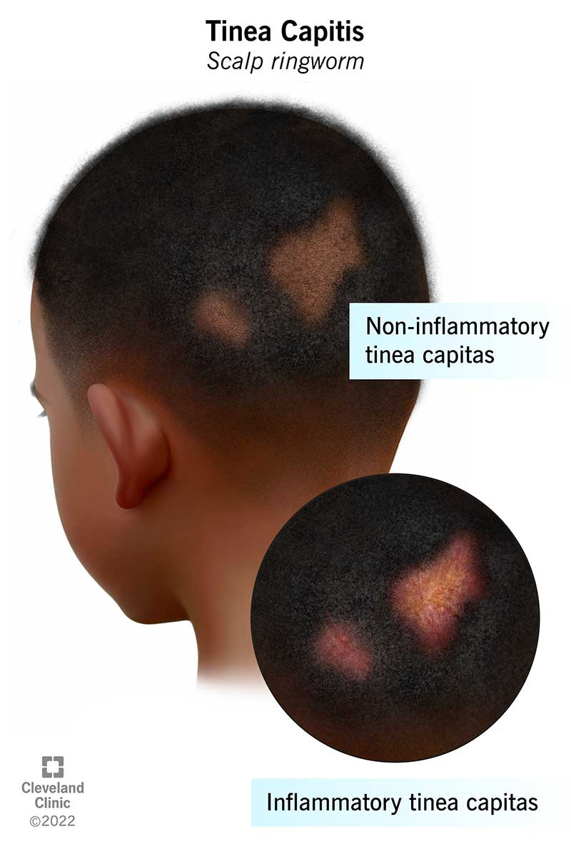 Tinea capitis is a fungal infection that affects your child’s scalp and hair. It can cause patches of hair loss and redness on your child’s scalp.