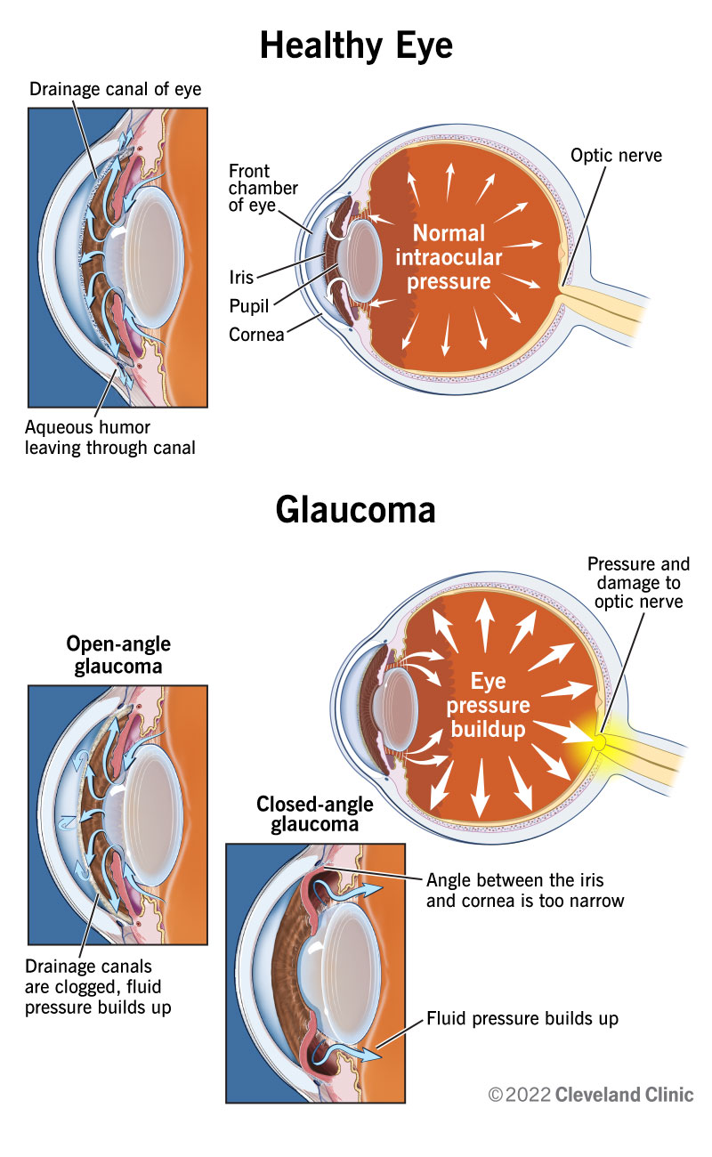 Glaucoma is characterized by fluid and pressure in your eye building up and damaging your optic nerve.