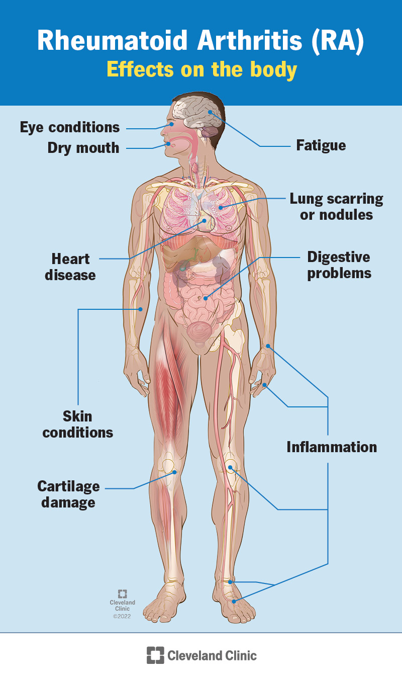 Rheumatoid arthritis affects many body systems.
