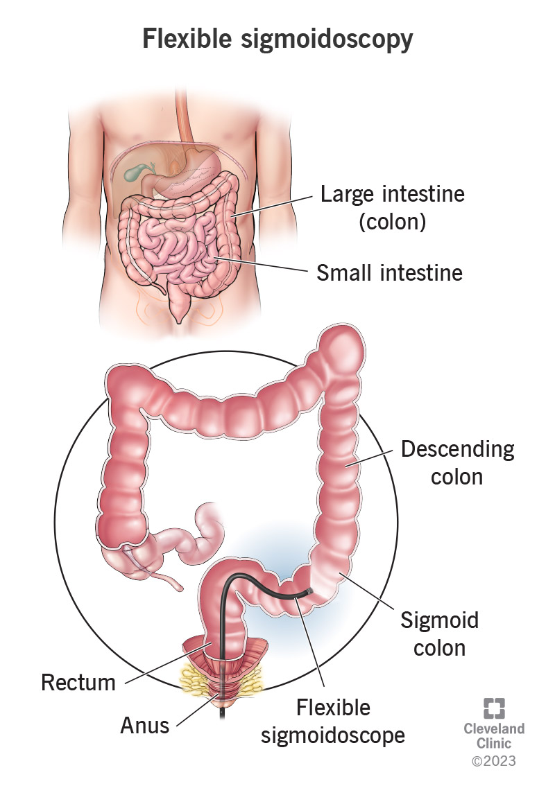 A flexible tube (sigmoidoscope) entering the sigmoid colon.