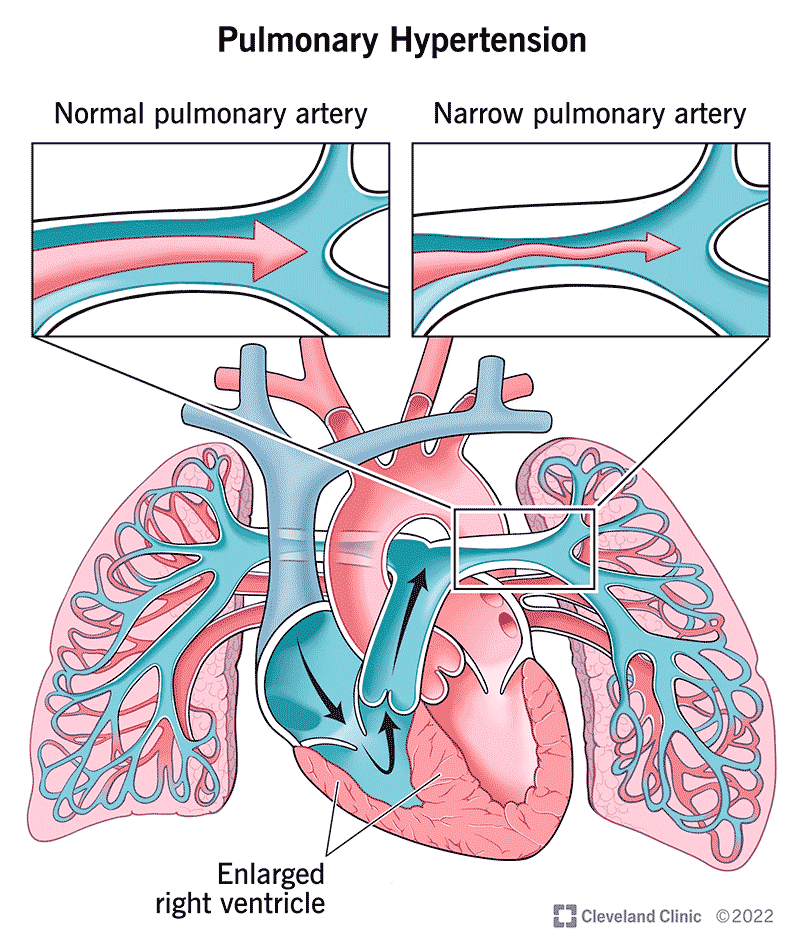 Illustration showing blood flow from your heart to your lungs.