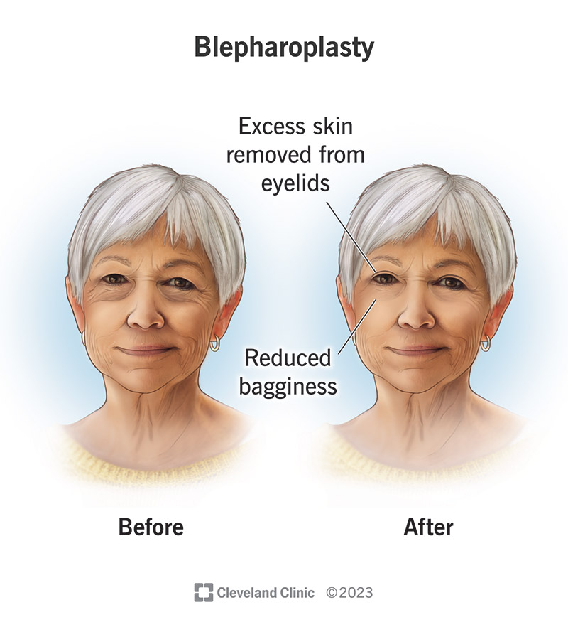 Before and after a blepharoplasty procedure.