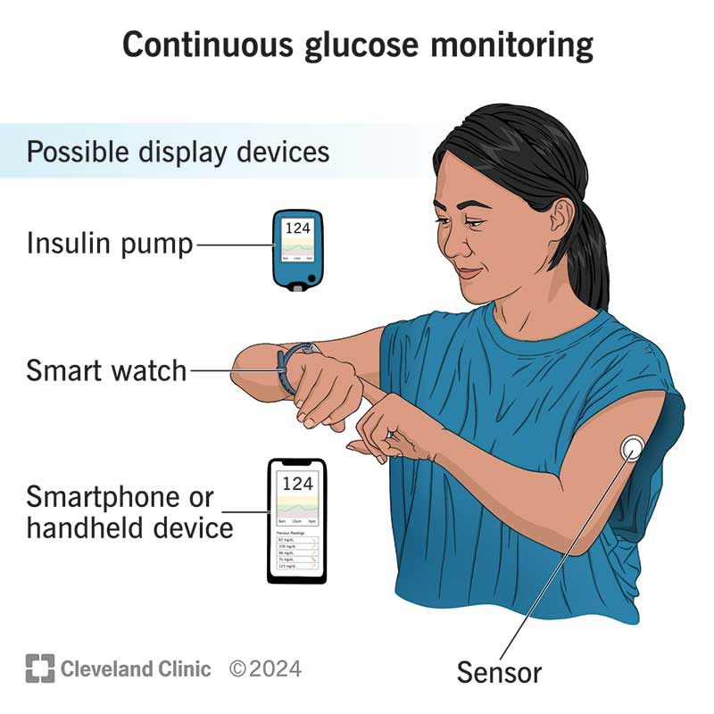 Types of display devices for continuous glucose monitors: insulin pump, smartwatch, smartphone or handheld device