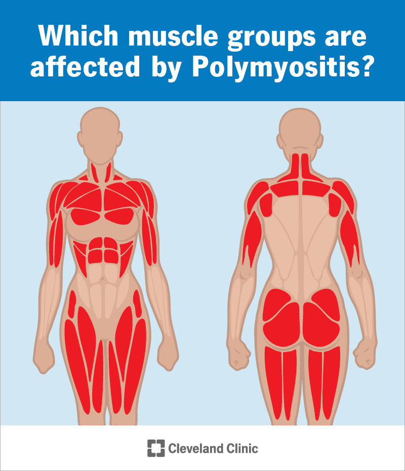 Polymyositis usually affects muscles near the center of your body.