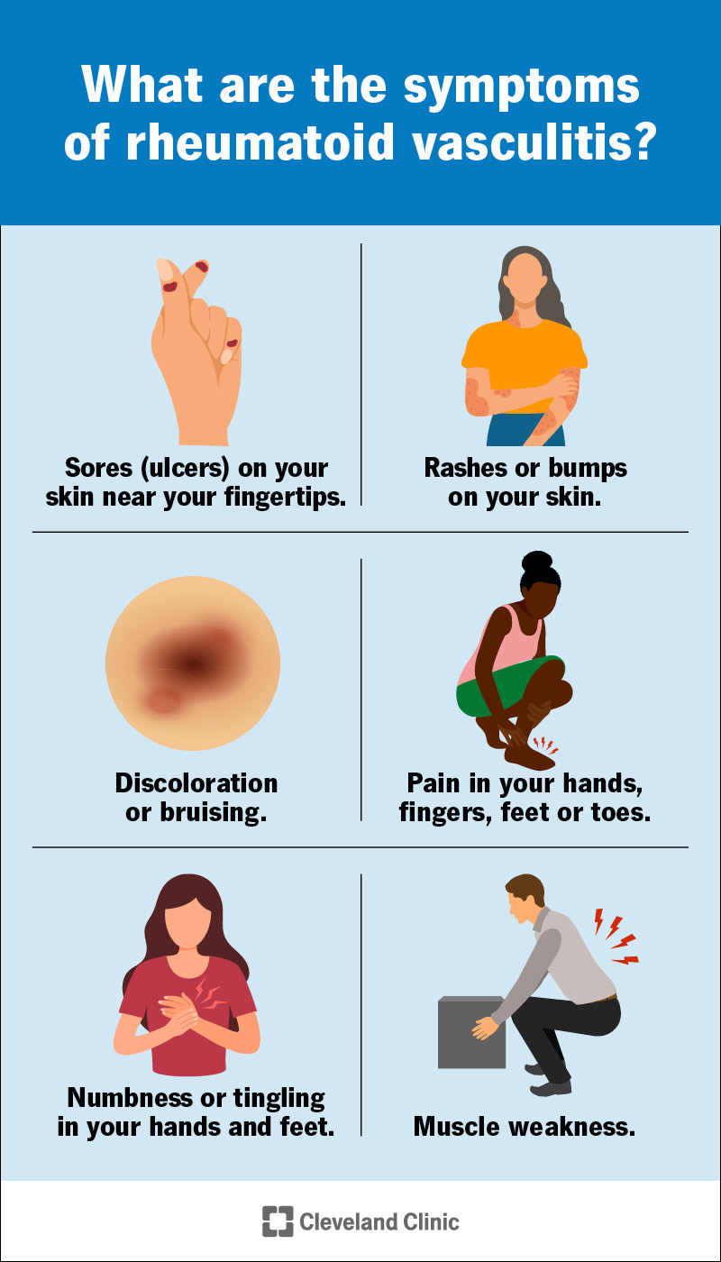 Rheumatoid vasculitis can cause symptoms throughout your body