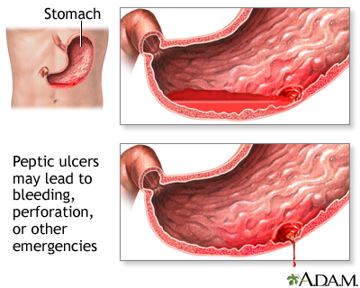 Ulcer emergencies