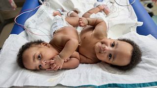 Imagen de los gemelos unidos, Amari y Javar Ruffin, en el Hospital Infantil de Filadelfia, el 20 de marzo de 2024.