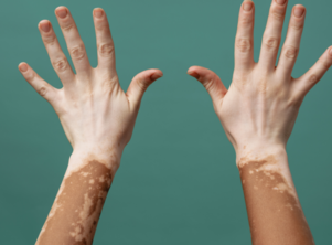 Holistic ways to heal skin disorders like vitiligo and psoriasis