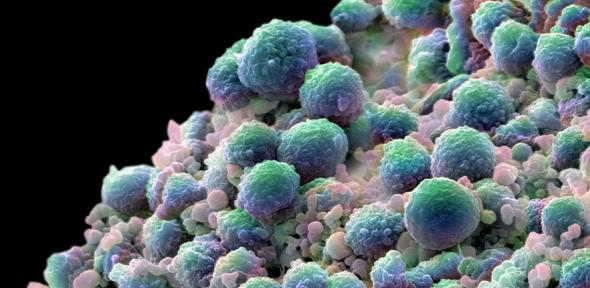 A colour-enhanced image showing a clump of prostate cancer cells