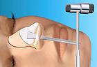 Virtual Closed Rhinoplasty