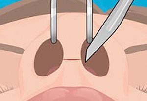 Operate Now: Nose Surgery